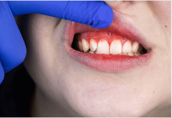 Gingivitis Affected Mouth